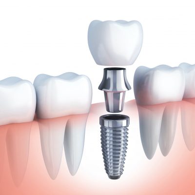implante-dental implante-dental
