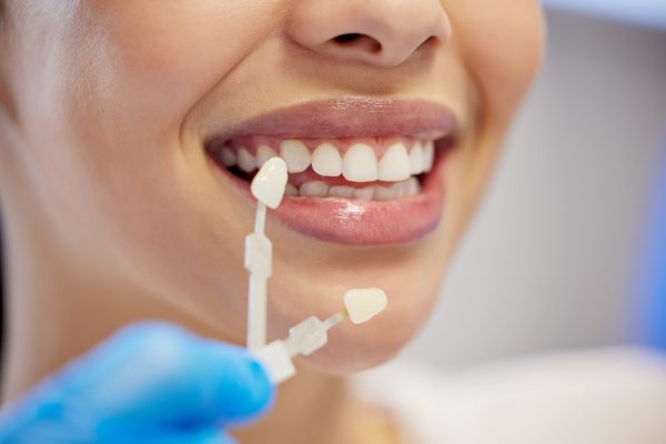 ¿Qué son las carillas dentales y para qué se utilizan?